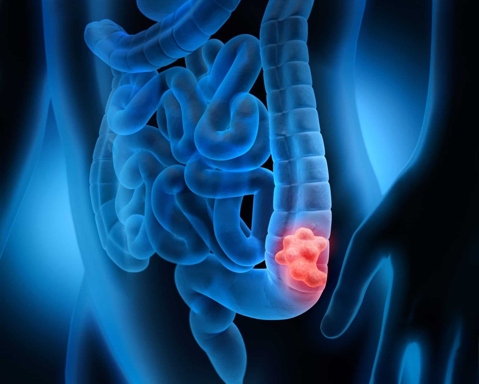 Colon Cancer Symptoms Diagnosis And Treatment