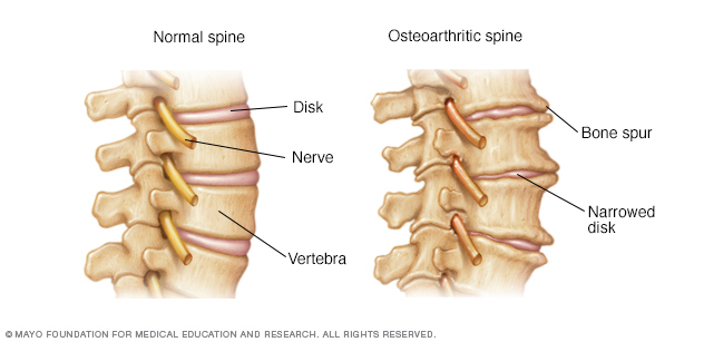 osteoarthritis