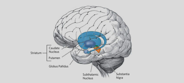 Huntington’s Disease