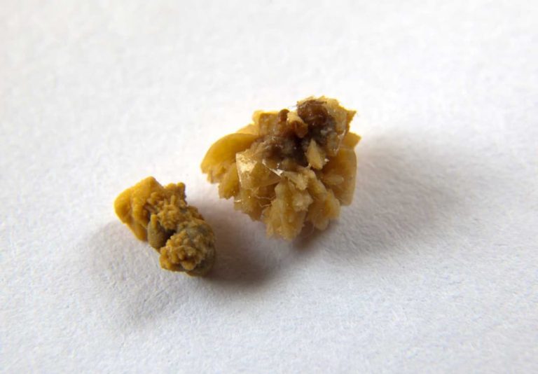 Kidney Stone