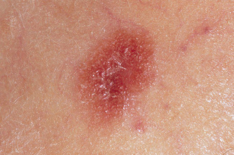 skin-cancer-causes-symptoms-treatment-and-prevention