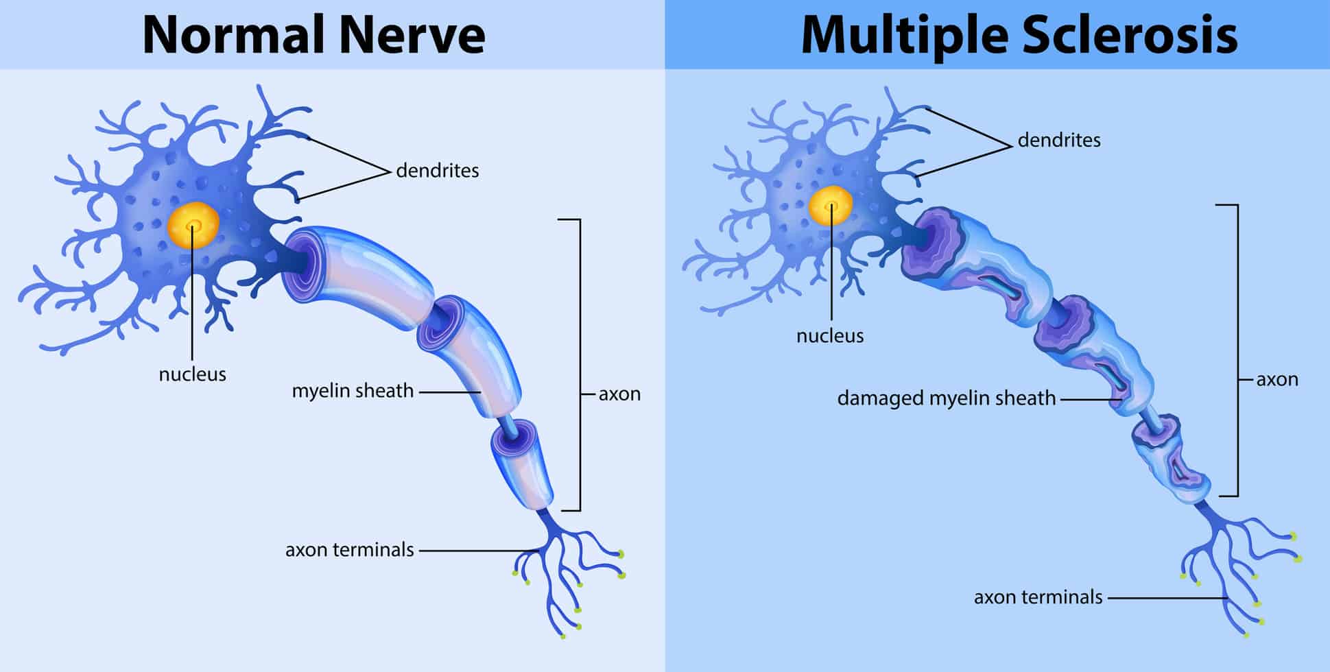 How Does Temperature Affect Multiple Sclerosis at Angus Heyward blog